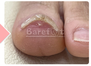 9回施術後（補正継続中）