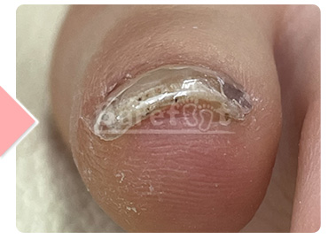 4ヶ月後（補正継続中）