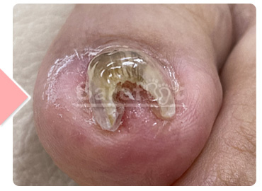 初回施術後 正面