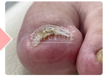 6回施術後 正面（補正継続中）