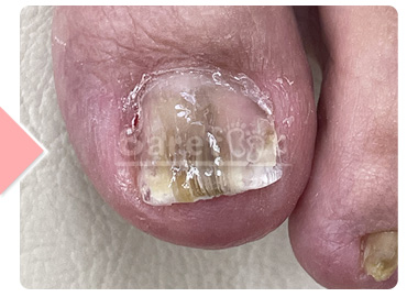 6回施術後 上から（補正継続中）