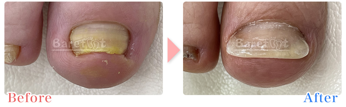 陥入爪の補正、正面