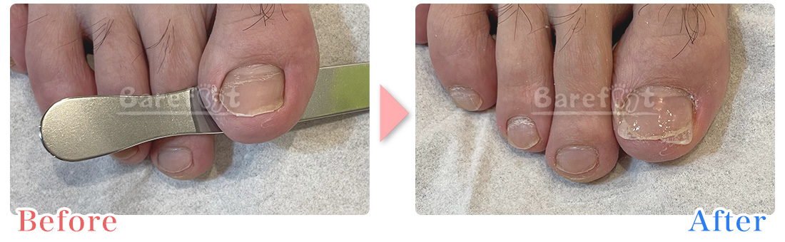 陥入爪の補正、上面