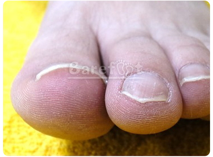 軽度の巻き爪例