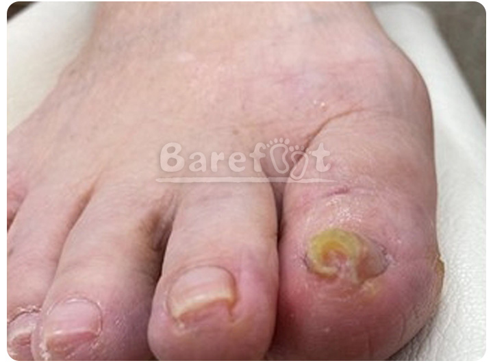 重度の巻き爪例